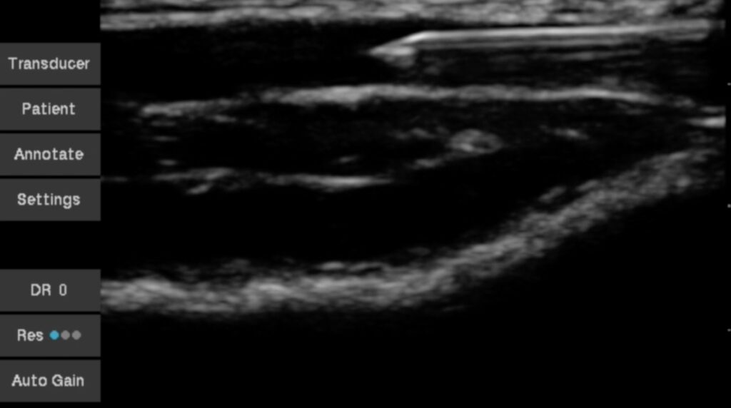 Ultraschall Gefässpunktion Venenpunktion arterielle Punktion
